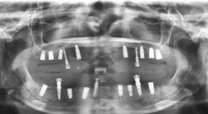 CAY-IMPLANT1