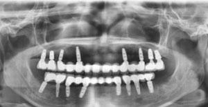 RANG-IMPLANT1