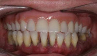 dental-implant-1