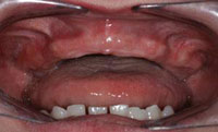 dental-implant-2
