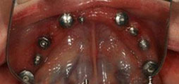 implant-ham-duoi-ok1