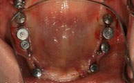 implant-ham-tren-1