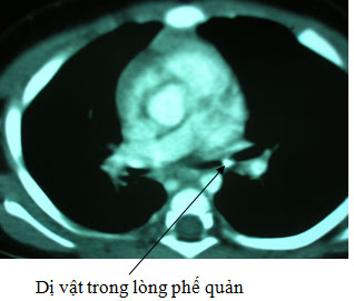 manh-xuong-trong-phoi-2