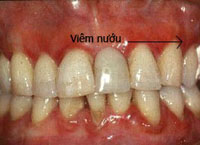 viem-nuou-10