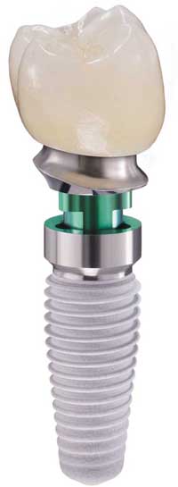 IMPLANT_TOOTH